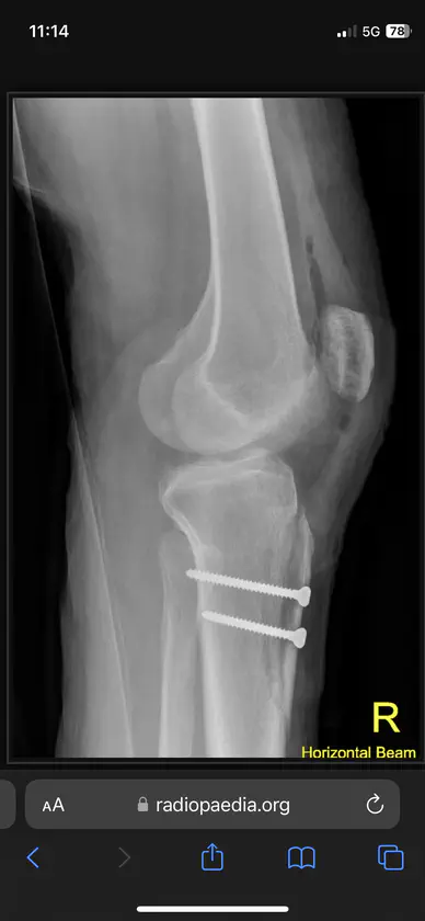 Tibial Tubercule Osteotomy