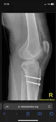 Tibial Tubercule Osteotomy