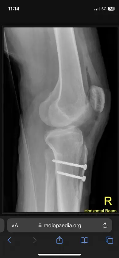 Tibial Tubercule Osteotomy