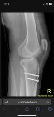 Tibial Tubercule Osteotomy